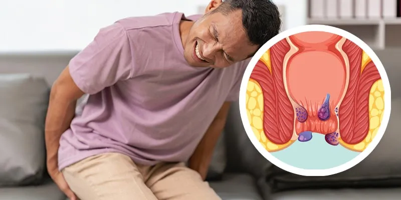 Wasir Kambuh Terus? Coba Cek Lagi Kebiasaan Toiletmu